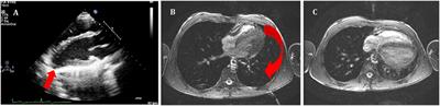 Echocardiographic Evaluation of Pericardial Effusion and Cardiac Tamponade